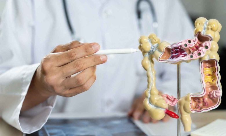 Cancer colorectal : la piste des pesticides relance le débat sur les cas précoces Cancer colorectal : la piste des pesticides relance le débat sur les cas précoces